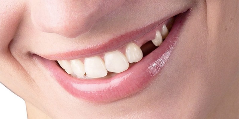 Nguyên nhân nằm mơ thấy rụng răng là gì?